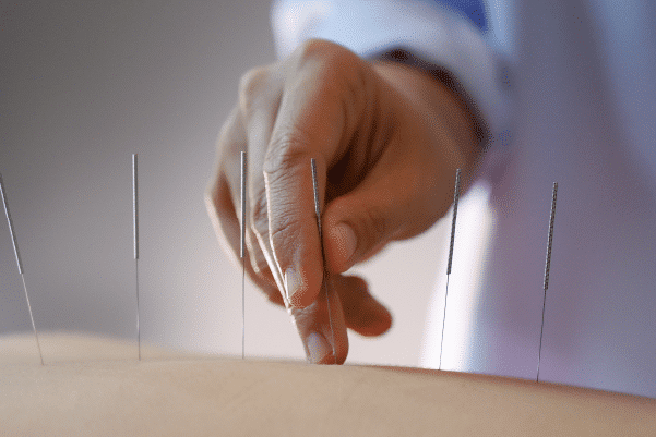 Photo acupuncture women who are the back and acupuncture treatment