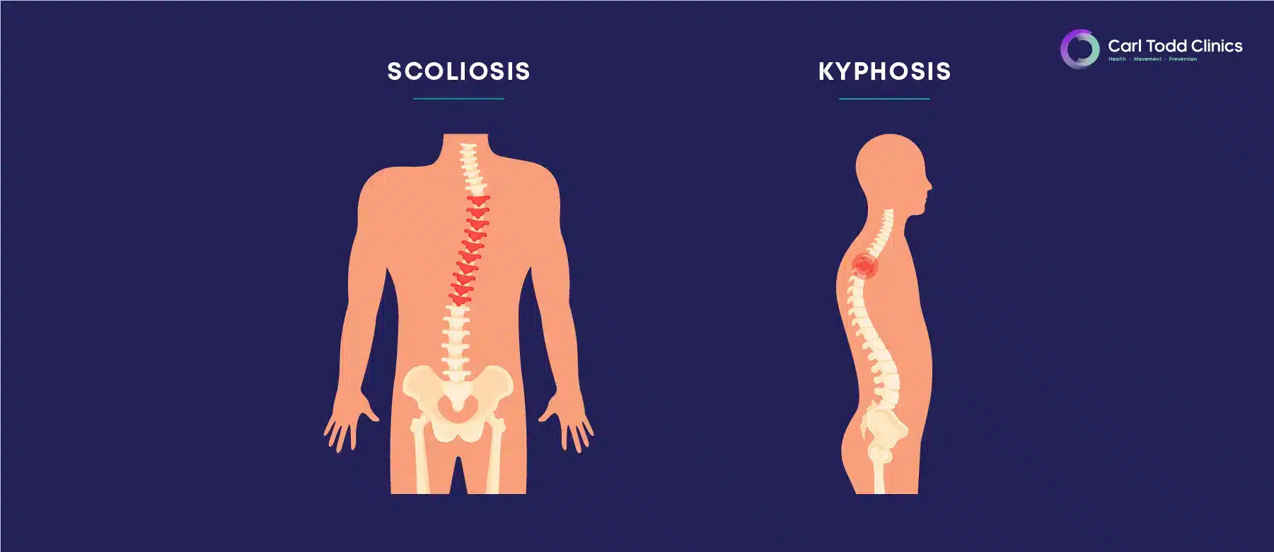 Scoliosis spine example, with Kyphosis